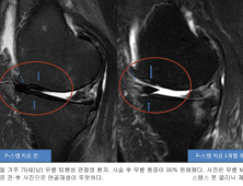 무릎 퇴행성 관절염, 신발 교정 깔창으로 고친다.