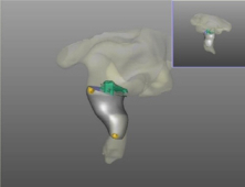 딜라이트 보청기, 3D프린터로 내 귀에 꼭 맞는 보청기 제작