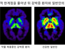 강박증 증상 호전되어도 약물치료 중단 말아야