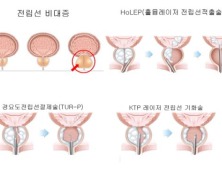 오승준 교수 “전립선비대증 환자 레이저 홀렙수술 만족”