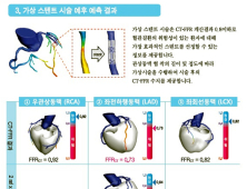 고통없이 저렴하게 협심증, 심근경색 예측
