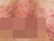 지긋지긋 따라다니는 지루성피부염 극복방법은?