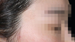 생후 3개월 이내, 40~70세, 성인남자 5%가 겪는 지루성피부염?