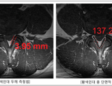 척추관 협착증, 새로운 진단법 찾았다