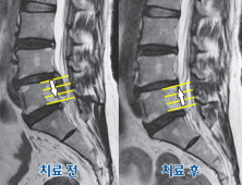 한방통합치료를 받은 허리디스크 환자 90% 만족