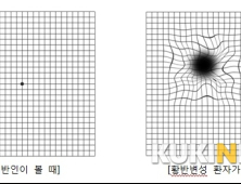 [질환 바로알기-황반변성안병증] 선이 구불구불, 검은 점 보인다면?