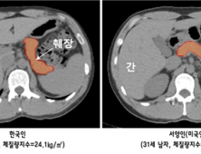 한국인, 서양인 비해 당뇨병 잘 걸리는 이유는…작은 '췌장 크기' 원인