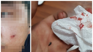 [단독] 칼날 조각 얼굴 안에 둔 채 봉합…병원 측 