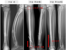합병증 줄인 '골형성부전증' 골 고정장치 개발…어린 환자에 도움될 듯