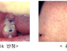 필리핀·우크라이나 홍역 발생 지속…영아도 예방접종 필요