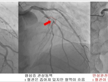 가슴 답답 ‘협심증’ 환자가 늘고 있다… 놔두면 심근경색·사망으로