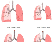 4기 폐암 환자도 수술 가능…