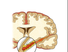 뇌졸중·뇌경색, 자칫하면 평생 후유증...이르면 30대부터