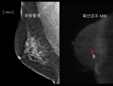 조영제 없이 숨어있는 유방암 찾아낸다 