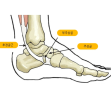 자녀의 복사뼈 아래 부위가 심하게 부어 있으면 ‘부주상골증후군’ 의심