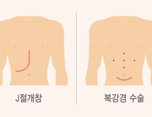 20대 딸이 어머니에 간 기증...