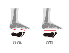 [건우리포트]  선천성 평발 Vs. 후천성 평발, 부주상골증후군