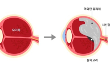 “눈에 날파리 떠다녀”…‘비문증’이 뭐길래 국민청원에?