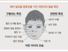 짧은 코⋅낮은 지능⋅정서불안...'임신 중 음주'로 아이가 겪는 문제