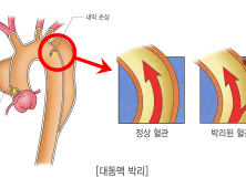 '초응급' 대동맥 박리, 20년 새 수술 성공률 98%