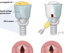 성대 절제한 뒤 손상된 목소리 재생하는 수술법 개발