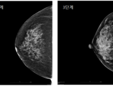 한국 여성, 유방암 위험 높은 이유있었다?