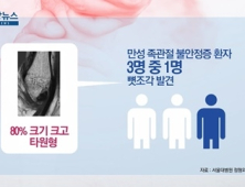 [쿠키건강뉴스] 발목 뼛조각 3명 중 1명 방치…“적극적 치료 고려해야”