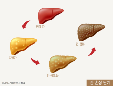 비알콜성 지방간염, 치료제 개발 실마리 찾았다