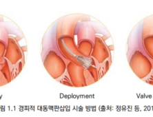 안전·유효성 확인됐는데...예비급여만 5년째 타비시술 이유는?