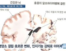 [쿠키건강뉴스] “60세 이상 여성, 체중 감소 클수록 치매 위험 높아”