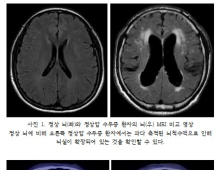 노인 100명 중 2명은 '정상압 수두증'…'파킨슨병' 동반되기도