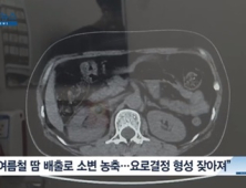 [쿠키건강뉴스] 요로결석, 50대 환자 가장 많아…발병 8월에 최다