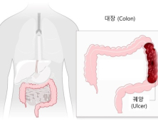 궤양성대장염, 10년새 4.8배 급증…이유는