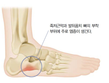 샌들·슬리퍼 신으니 ‘지끈’… 족저근막염 예방하려면 [Q&A]