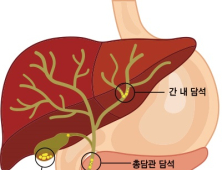 담낭·담관에 생긴 돌, 그냥 가지고 있어도 될까? [건강 나침반] 