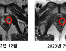 국내 첫 중입자치료 받은 60대, 전립선암 조직 제거됐다
