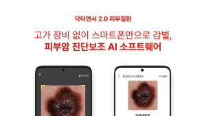  “휴대폰으로 피부암 감별”…AI 소프트웨어 임상 성공