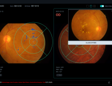 안저 영상 판독 ‘뷰노메드 펀더스’, 혁신의료기기 통합심사 승인