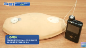 첨단기기가 만드는 새로운 장기, ‘인공췌장’ [이노메디④]