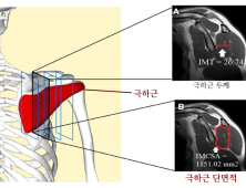 견갑상신경 포착증후군, 새 진단 기준 찾았다