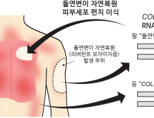 희귀 피부병 치료법 찾았다…“돌연변이 피부세포 이식 성공”