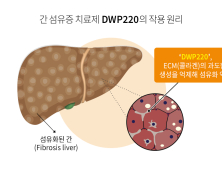 대웅제약, 중증 간 섬유증 ‘먹는 치료제’ 세계 첫 개발 나선다 